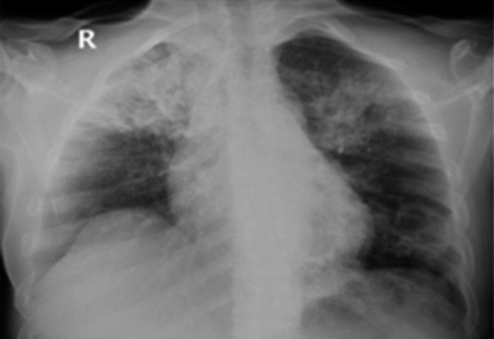 This diagnostic image is a frontal (posteroanterior) chest X-ray demonstrating significant bilateral pulmonary pathology. In the right lung, there is a dense, heterogeneous lobar consolidation primarily occupying the right upper lobe. Within this opacification, a radiolucent area is visible, highly suggestive of cavitation. The left lung displays sublobar, patchy infiltrates and consolidation, also predominantly in the upper zone, with subtle features indicating potential central cavitation. The cardiac silhouette appears within normal limits, though the mediastinal borders are partially obscured by the adjacent pulmonary opacities. These findings are classically associated with infectious processes such as pulmonary tuberculosis (TB) or necrotizing pneumonia. In the provided clinical context of a co-infection involving COVID-19 and tuberculosis, the imaging illustrates the characteristic upper-lobe predilection and cavitary nature of reactivated TB, while the more diffuse patchy elements may represent overlapping viral pneumonia patterns.