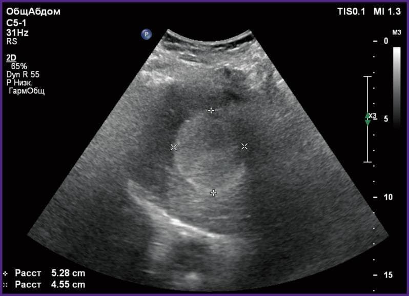 This diagnostic image is a 2D grayscale abdominal echosonogram (ultrasound) demonstrating a hepatic hemangioma in a 42-year-old patient. The lesion is located within the liver parenchyma and presents as a well-defined, predominantly hyperechoic mass with internal heterogeneous texture, including minor hypoechoic areas. The mass exhibits slightly irregular borders and appears to exert a mild mass effect on the surrounding hepatic tissue. Caliper measurements are visible on the image, marking the lesion's dimensions as 5.28 cm and 4.55 cm. Technical annotations include TIS 0.1, MI 1.3, and transducer settings for a C5-1 curved array probe. A depth scale on the right indicates the imaging field extends to approximately 15 cm. This image illustrates the typical sonographic appearance of a large cavernous hemangioma, a common benign vascular liver tumor, and is used in radiology education to distinguish focal liver lesions based on echogenicity and morphology.