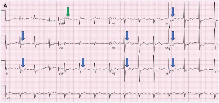 A 12-lead diagnostic electrocardiogram (ECG) demonstrating a critical pattern of diffuse myocardial ischemia. The tracing shows marked ST-segment elevation in lead aVR (indicated by a green arrow), which is a significant indicator of potential left main coronary artery (LMCA) occlusion or triple-vessel disease. This is accompanied by widespread, horizontal to down-sloping ST-segment depression (indicated by blue arrows) across multiple lead groups, specifically in the inferior leads (II, III, aVF) and the anterolateral leads (I, aVL, V2, V3, V4, V5, V6). Lead V1 remains relatively neutral compared to the other leads. The rhythm appears to be atrial fibrillation, characterized by an irregularly irregular rhythm and the absence of clear P-waves. This visual pattern is classically associated with severe subendocardial ischemia or global myocardial oxygen supply-demand mismatch, often seen in acute coronary syndrome. The image serves as a high-level educational resource for identifying high-risk ECG signatures that require urgent cardiovascular intervention.