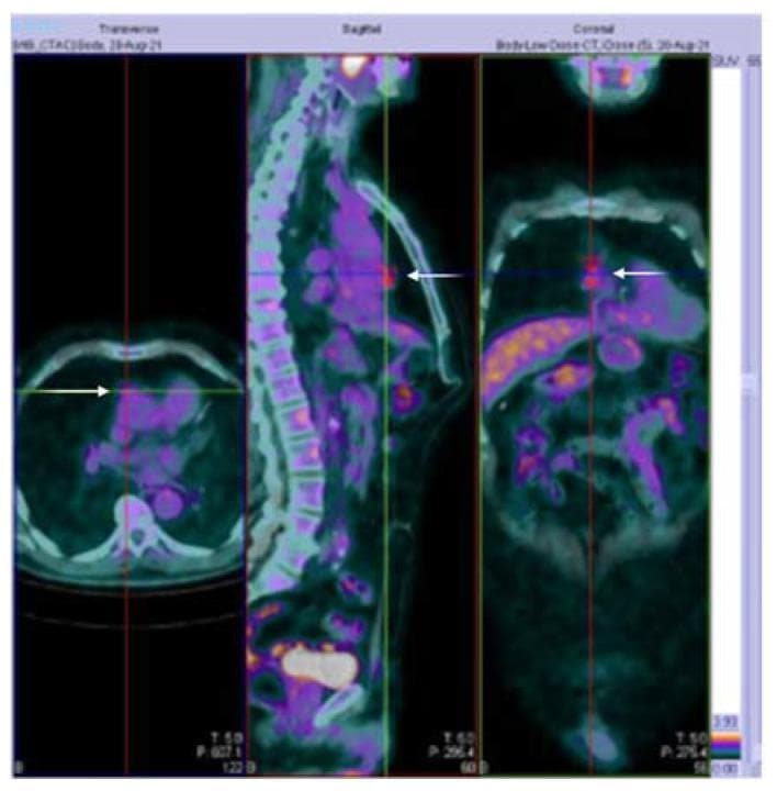 This diagnostic image displays fused 18F-FDG PET-CT scans in transverse, sagittal, and coronal (frontal) planes. The primary finding is an area of moderate metabolic activity in the anterior mediastinum, indicated by white arrows in all three views. In the transverse plane, the mass is located centrally, posterior to the sternum and anterior to the heart and great vessels. The sagittal view clearly demonstrates the anterior position of the hypermetabolic lesion relative to the vertebral column and its vertical longitudinal extent. The coronal view reveals the transverse width and midline orientation of the mass. The PET signal shows a maximum standardized uptake value (SUV) of 3.16, visualized as a color-coded hot spot. This localized FDG uptake within the anterior mediastinum is characteristic of a thymic mass, such as a thymoma. The CT component provides anatomical localization, helping differentiate the lesion from surrounding mediastinal structures and lung tissue. This radiological study is critical in the evaluation of patients presenting with symptoms of myasthenia gravis, such as ptosis and muscle fatigue.