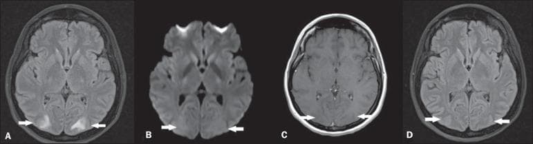 Diagnostic axial brain MRI series illustrating Posterior Reversible Encephalopathy Syndrome (PRES). Panel A (FLAIR) shows hallmark bilateral, symmetric hyperintensities in the white matter of the occipital lobes, indicative of vasogenic edema. Panel B (Diffusion-Weighted Imaging) demonstrates no restricted diffusion in these areas, confirming the absence of cytotoxic edema or acute infarction. Panel C (T1-weighted post-contrast) shows no pathological gadolinium enhancement, highlighting the lack of blood-brain barrier breakdown. Panel D (Follow-up FLAIR at 4 weeks) shows complete radiological resolution of the previous hyperintense lesions. This comparison demonstrates the classic reversible neuroimaging features of vasogenic edema associated with PRES, typically seen in clinical contexts such as hypertensive crisis, preeclampsia, or immunosuppressive therapy.