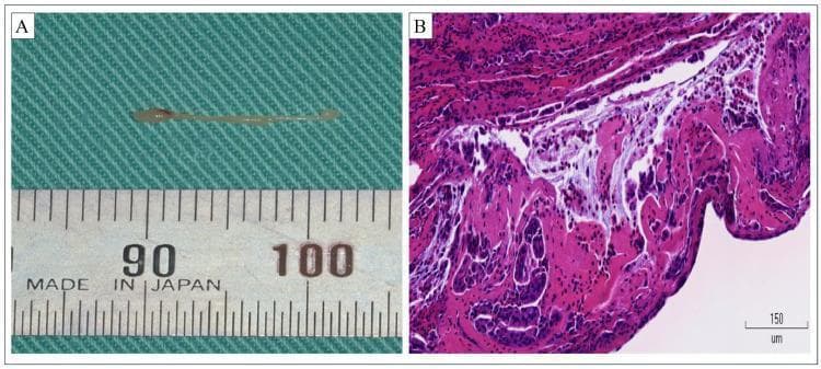 This composite image illustrates the macroscopic and microscopic features of an eosinophilic salivary plug discharged from the parotid gland. Panel A is a clinical photograph showing a macroscopic view of a white, elongated, and translucent fibrous mass, approximately 13 mm in length, against a metric ruler. This mass represents an 'allergic plug' typical of eosinophilic sialadenitis (Kussmaul disease). Panel B is a photomicrograph of the same tissue stained with hematoxylin and eosin (H&E) at high magnification (scale bar 150 µm). The histology reveals a dense inflammatory exudate dominated by eosinophils, characterized by their bright eosinophilic (pink) cytoplasm and bilobed nuclei. These cells are embedded within a network of amorphous eosinophilic fibrin. Additionally, fragments of degenerated ductal epithelial cells are visible, indicating the obstructive nature of the plug within the salivary duct system. The combination of findings is characteristic of chronic obstructive sialadenitis with an allergic or eosinophilic etiology, often seen in patients with comorbid asthma or sinusitis.