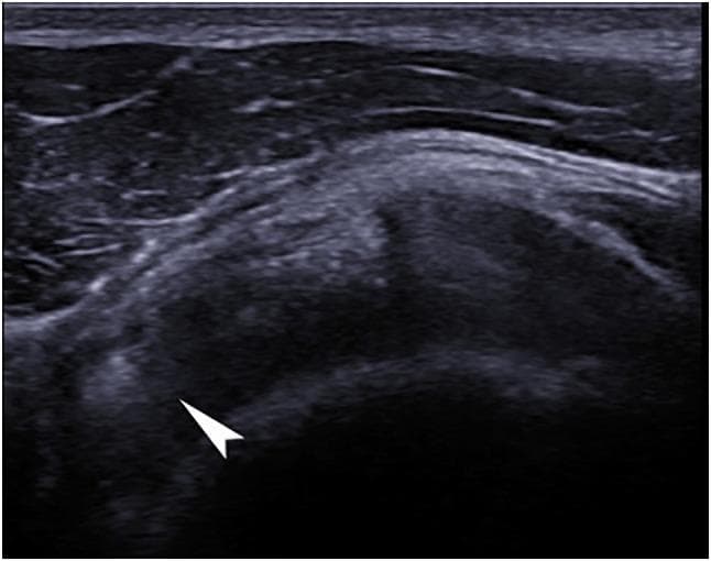 A diagnostic ultrasound image of the right shoulder in a coronal plane, specifically capturing the supraspinatus tendon while the arm is in forced internal rotation. The image reveals a focal hyperechoic formation (indicated by a white arrow) within the tendon substance, characteristic of calcific tendinitis. The lesion is notably brighter than the surrounding tendon tissue and demonstrates posterior acoustic enhancement, which suggests a dense calcification. The adjacent supraspinatus tendon fibers show a heterogeneous echotexture with subtle areas of varied echogenicity, indicative of underlying tendinosis or degenerative changes. The humeral head and overlying deltoid muscle are visible as anatomical landmarks. This imaging is utilized in sports medicine and orthopedics to diagnose rotator cuff pathology, specifically distinguishing between degenerative tears and calcific deposits.