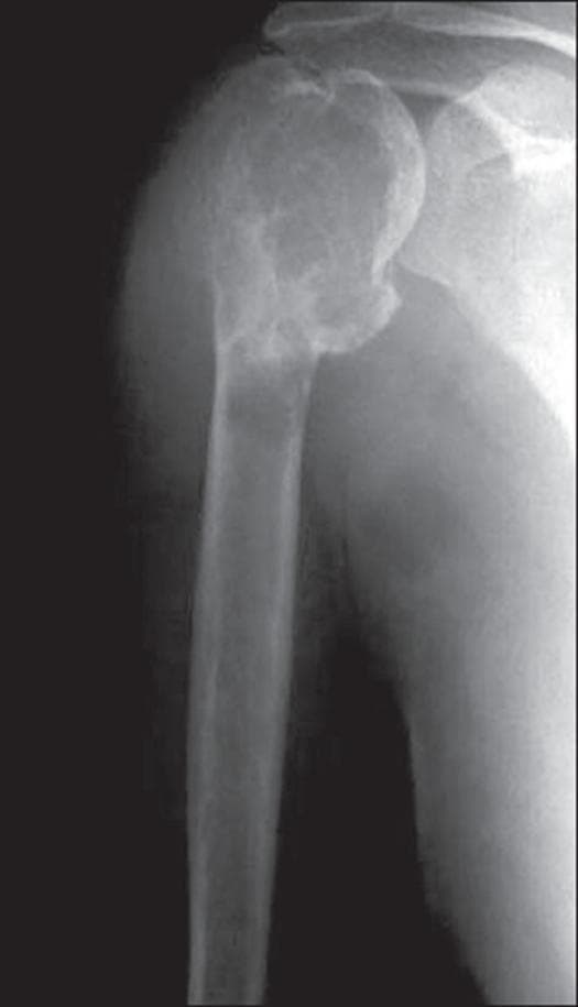 This anteroposterior radiograph of the shoulder demonstrates a large, locally aggressive lytic lesion in the proximal humerus, characteristic of a Giant Cell Tumor (GCT). The lesion is centered in the epiphysis but extends distally into the metaphysis and reaches the subchondral bone plate. Key radiographic features include a multi-loculated or 'soap-bubble' appearance created by prominent bony ridges and internal trabeculations. There is significant expansion of the bone contour with extensive cortical thinning and destruction, particularly along the lateral aspect. The margins of the lesion are relatively well-defined (geographic bone destruction) without a sclerotic rim, indicating its osteolytic nature. The absence of visible matrix mineralization and its eccentric placement in the subarticular region are classic diagnostic hallmarks of GCT in a skeletally mature patient. This image serves as an educational example of primary bone tumor morphology and the assessment of cortical integrity in musculoskeletal oncology.