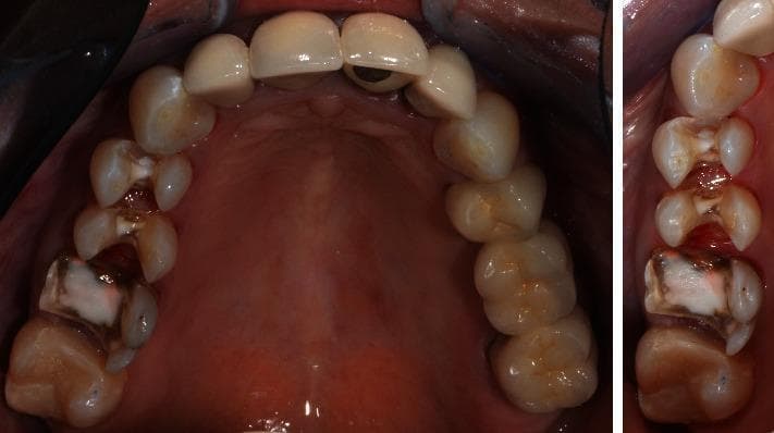 This clinical intraoral photograph displays a series of cavity preparations on the right maxillary posterior teeth (specifically teeth 14, 15, and 16). The preparations follow biomechanical principles for CAD/CAM ceramic restorations, featuring rounded internal line angles and smooth, distinct margins. Within the cavities, a light-colored, opaque composite base material (core build-up) is visible, used to level the cavity floors and protect endodontic access sites. Significant tooth-structure discoloration and staining are present on the prepared molar (tooth 16), likely indicative of previous restorative leakage or long-term endodontic treatment effects. The adjacent gingival tissues appear pink and healthy, with firm adaptation and no signs of acute inflammation or recession. The surrounding dental arch includes existing aesthetic restorations on the anterior and left posterior segments, demonstrating a comprehensive rehabilitative clinical scenario. This image is used to illustrate prosthetic preparation techniques, base placement, and preoperative assessment in restorative dentistry.