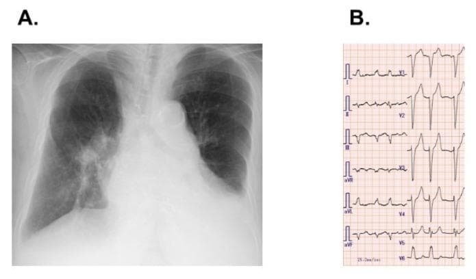 This composite diagnostic image features a posteroposterior chest X-ray (A) and a multi-lead electrocardiogram (B). The chest radiograph demonstrates mild cardiomegaly with a widened cardiac silhouette. There is prominent dilatation of the pulmonary artery segment, suggesting pulmonary hypertension. Bilateral blunting of the costophrenic angles is visible, consistent with mild pleural effusions, more pronounced on the left side. The electrocardiogram (ECG) tracing reveals an irregular ventricular rhythm without discernible P-waves, replaced by fine fibrillatory oscillations characteristic of atrial fibrillation. The QRS complexes are significantly widened with a morphology consistent with a complete left bundle branch block (LBBB), specifically showing deep S-waves in the right precordial leads (V1-V3) and broad, notched R-waves in the lateral leads (aVL, V5, V6). This combination of imaging and electrophysiological findings is highly relevant to cardiovascular medicine, particularly in the context of heart failure, pulmonary vascular disease, and rhythm management.