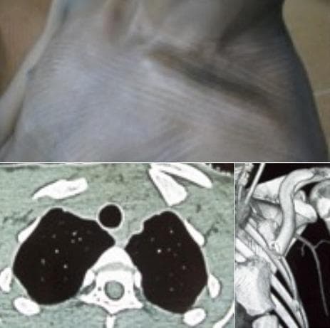 This composite medical image illustrates a complex left clavicle fracture through three distinct modalities: clinical photography, axial computed tomography (CT), and 3D CT reconstruction. The upper clinical photograph shows a visible deformity of the left supraclavicular and sternoclavicular region, characterized by an anterior protrusion of the bone fragment and an associated posterior 'doubling' or displacement. The lower-left axial CT scan at the level of the thoracic inlet demonstrates a fractured clavicle with significant internal rotation and displacement, resulting in a mass effect on the underlying pleural dome. The lower-right 3D reconstruction provides a spatial visualization of the fracture's orientation, showing the nearly 180-degree rotation of the clavicular segment relative to its normal anatomical position. This case serves as an educational example of orthopaedic trauma where severe bony displacement impacts adjacent thoracic structures, specifically highlighting the risk of pleural compression and neurovascular injury in medial clavicle fractures.