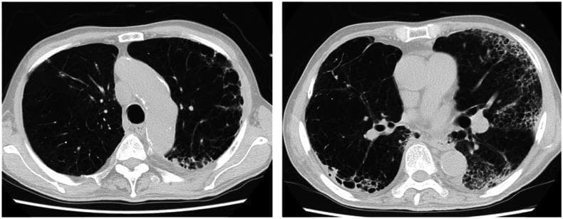 Two axial non-contrast computed tomography (CT) sections of the thorax demonstrate advanced pulmonary pathology. The images show significant bilateral emphysematous changes characterized by diffuse areas of low attenuation, representing lung parenchyma destruction and air trapping. There is a prominent peripheral and subpleural distribution of these lucent areas, particularly in the posterior lung zones. Notably, there are increased linear and reticular opacities along the margins of the emphysematous regions, suggesting a honeycomb-like pattern or fibrotic architectural distortion. These findings are consistent with severe chronic obstructive pulmonary disease (COPD) with underlying paraseptal or bullous emphysema, and potentially secondary interstitial changes. The visual highlights the importance of recognizing the distribution patterns of emphysema and associated peripheral opacities in geriatric patients with progressive dyspnea and obstructive lung disease.