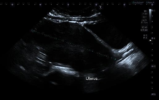 This transabdominal ultrasound image displays a bulky, anteverted uterus with heterogeneous myometrial echogenicity. Key diagnostic features include multiple intramural fibroids (leiomyomas), visible as discrete, hypoechoic to isoechoic masses distorting the uterine contour. The largest identified fibroid is located in the fundal region. Centrally, the endometrium appears thickened and poorly defined, lacking a clear interface with the surrounding myometrium, which is common in transabdominal scans of a distorted uterus. The image illustrates the ultrasound appearance of uterine leiomyomatosis, a common cause of menorrhagia and iron deficiency anemia in gynecological clinical practice. Caliper marks are visible, indicating the measurement of the long axis of the bulky uterus.
