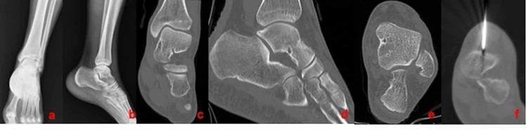 This multi-panel diagnostic figure displays the orthopedic imaging of a 24-year-old male with an osteoid osteoma in the talus. Panels A and B are anteroposterior (AP) and lateral X-ray views of the ankle and foot, showing general bony anatomy including the distal tibia, fibula, talus, and calcaneus. Panels C, D, and E provide multi-planar CT reconstructions in coronal, sagittal, and axial planes, respectively. These views reveal a characteristic small, well-defined radiolucent nidus within the talar bone, surrounded by reactive cortical thickening and sclerosis typical of osteoid osteoma. Panel F is a procedural axial CT scan demonstrating the intraoperative localization and placement of a radiofrequency ablation (RFA) needle directly into the lesion. The series illustrates the diagnostic pathway from conventional radiography to advanced cross-sectional imaging and subsequent minimally invasive therapeutic intervention in a clinical musculoskeletal oncology context.