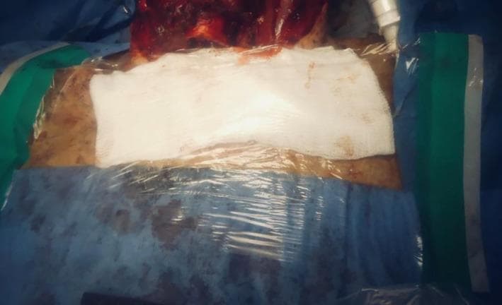 A clinical photograph depicting a post-operative surgical field following a tracheostomy procedure. The central focus is a closed airway system where a white gauze pad is placed over the stoma site, secured and sealed with a large Tegaderm transparent film dressing to minimize aerosolization. A J-shaped Rusch endotracheal tube is visible, extending into the stoma to maintain ventilation. The surgical site is surrounded by sterile blue and green surgical drapes. Superior to the dressing, the operative field shows exposed tissue with visible blood and skin markings, consistent with a laryngectomy or major neck surgery. The image illustrates infection control protocols, specifically the use of physical barriers and transparent dressings to maintain a closed circuit and prevent the spread of droplets or fomites during high-risk airway maneuvers in an operating room environment.