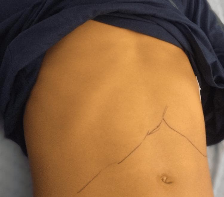 A clinical photograph of an adolescent patient's abdomen demonstrating significant jaundice (icterus) and organomegaly associated with acute Epstein-Barr virus (EBV) infection. The skin exhibits a diffuse, pathological yellowish discoloration. Dark ink markings are present on the abdominal surface to clinically delineate the inferior margins of the liver and spleen, indicating hepatosplenomegaly. The liver margin is traced across the right upper quadrant, while the splenic margin extends significantly below the left costal margin towards the umbilicus. The abdomen appears moderately distended with a rounded contour. This visual serves as a classic clinical representation of infectious mononucleosis complicated by hepatitis and cholestasis. The image is intended for medical education regarding the physical examination findings of hepatobiliary and reticuloendothelial involvement in systemic viral infections.