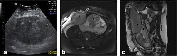 This composite of diagnostic images illustrates a Type III rectus sheath hematoma (RSH) in a 27-week pregnant patient. (a) Transverse transabdominal ultrasound shows a large, well-demarcated, heterogeneous mass measuring approximately 9.16 x 9.73 cm. The mass is partly hypoechoic and isoechoic, located adjacent to the uterine wall. (b) Axial MRI scan confirms a massive, hyperintense right-sided rectus sheath hematoma (1) that displaces the gravid uterus toward the contralateral side. The fetus (3) is visible in cephalic presentation, and edema is present in the overlying subcutaneous tissues. (c) Coronal MRI scan demonstrates the longitudinal extent of the hematoma (1), which measures 11 x 12 x 20 cm. It is positioned anterior and lateral to the uterus. The placenta (2) is clearly visualized on the posterior uterine wall, appearing normal with no signs of abruptio placentae or retroplacental hemorrhage. This case highlights the role of multimodality imaging in differentiating RSH from obstetric complications such as uterine myoma infarction or placental abruption during pregnancy.
