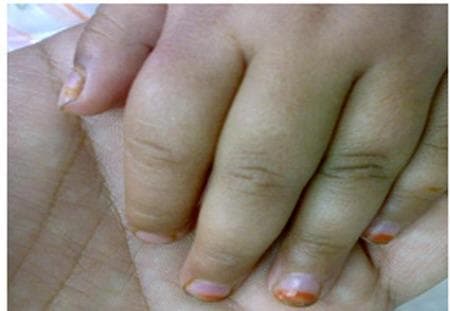 This clinical photograph displays a close-up view of a pediatric patient's hand demonstrating dactylitis, a hallmark clinical sign of sickle cell disease (SCD) often referred to as 'hand-foot syndrome.' The image shows marked, diffuse swelling of the second and third digits, characterized by a 'sausage-like' appearance. The fingers appear edematous and bulbous, particularly around the proximal interphalangeal (PIP) joints, with taut, shiny overlying skin indicating acute soft tissue inflammation. The nail beds exhibit slight pallor, consistent with the patient's associated severe anemia. Clinically, this presentation represents a vaso-occlusive crisis where sickle-shaped red blood cells obstruct small capillaries in the phalanges, leading to ischemia and painful infarction of the bone marrow and periosteum. This visual is a classic educational example of early-onset skeletal complications in toddlers with sickle cell anemia, illustrating the inflammatory response to microvascular occlusion in the extremities.