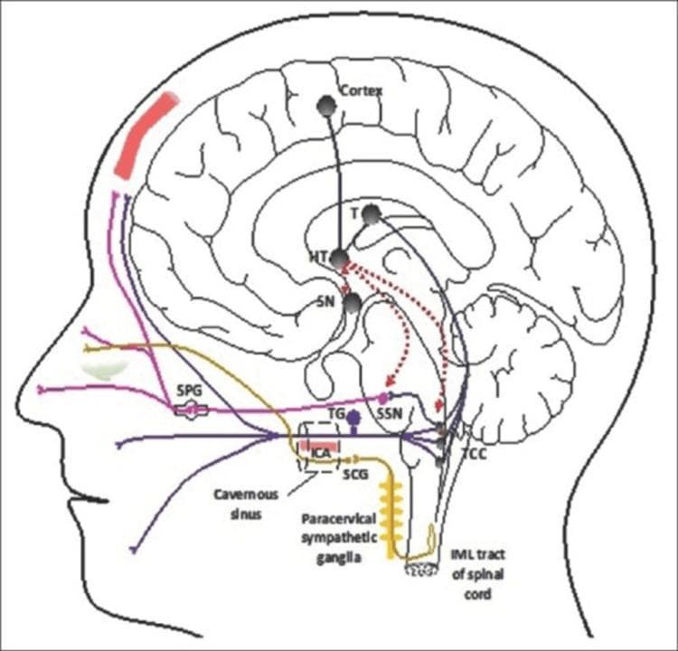 A pathophysiology diagram illustrating the neural pathways involved in cluster headaches within a sagittal view of the human head and brain. The diagram highlights the trigeminal-autonomic reflex arc. Key neural structures depicted include the hypothalamus (HT), which serves as a central hub with connections to the thalamus (T), suprachiasmatic nucleus (SN), superior salivatory nucleus (SSN), and the trigeminocervical complex (TCC). Sensory pathways are shown in purple and blue, originating from the dural structures and trigeminal nerve, synapsing in the TCC and projecting to the cortex. The parasympathetic pathway (pink) involves the SSN and sphenopalatine ganglion (SPG), leading to autonomic symptoms. The sympathetic pathway (yellow) is traced from the intermediolateral (IML) tract of the spinal cord through the superior cervical ganglion (SCG) and the plexus surrounding the internal carotid artery (ICA) in the cavernous sinus. Red dashed lines indicate the hypothalamic modulation of the SSN and TCC, which are critical in the pathogenesis of trigeminal autonomic cephalgias.