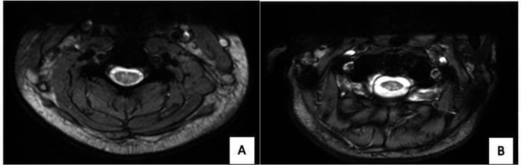 Two axial T2-weighted magnetic resonance imaging (MRI) scans of the spine (A: cervical region, B: thoracic region). The primary diagnostic feature is a symmetric, inverted V-shaped hyperintense signal within the dorsal columns of the spinal cord. This radiological finding, often referred to as the 'inverted V sign,' is highly characteristic of subacute combined degeneration of the spinal cord. The images demonstrate significant contrast between the high-signal pathology in the posterior cord and the normal intermediate signal of the surrounding cord parenchyma. Surrounding anatomical structures include the vertebral bodies (low signal bone), paraspinal muscles, and subcutaneous fat. The educational focus is on identifying neurologic sequelae of Vitamin B12 deficiency or nitrous oxide toxicity, illustrating the specific localization of degeneration in the dorsal columns responsible for proprioception and vibratory sense loss.