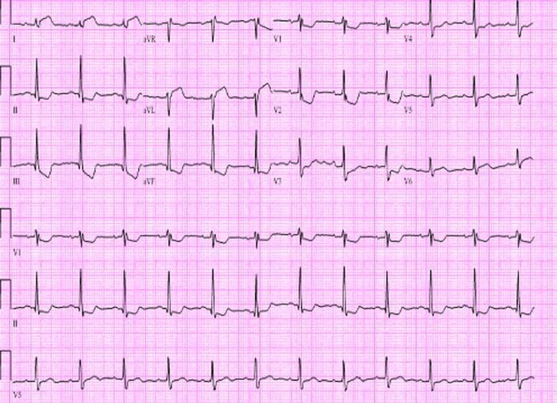 A 12-lead electrocardiogram (ECG) demonstrating visual evidence of an acute ST-elevation myocardial infarction (STEMI) with inferior and posterior wall involvement. The diagnostic image shows significant ST-segment elevation in the inferior leads (II, III, and aVF). Reciprocal ST-segment depression is visible in the lateral leads (I and aVL). Furthermore, the precordial leads V1 through V3 exhibit prominent R waves and marked ST-segment depression, which are highly suggestive of a concomitant posterior wall infarction. ST-T wave changes also extend into the lateral precordial leads (V4-V6). The QRS complexes appear relatively narrow, and the underlying rhythm is consistent with sinus tachycardia. This ECG illustrates the visual presentation of an acute coronary syndrome resulting from left circumflex artery or right coronary artery occlusion, emphasizing the importance of recognizing both primary elevations and reciprocal changes for comprehensive cardiac triage.