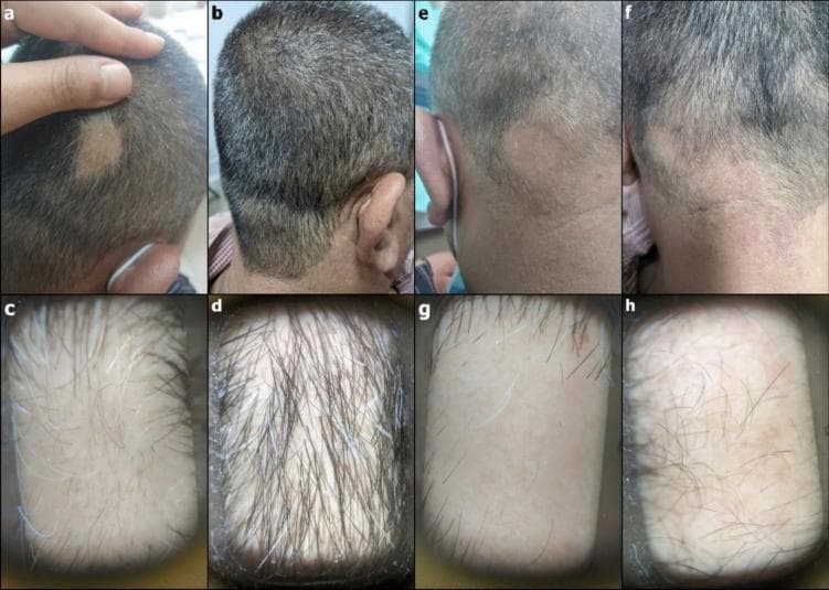 This composite educational graphic presents clinical and trichoscopic comparisons of alopecia areata treatment outcomes over a three-month period. The image is divided into two main comparison groups: a treated representative patch and an untreated control patch.
Panels (a) and (b) show the clinical progression of a well-defined, smooth, non-scarring bald patch on the scalp. Panel (a) illustrates the baseline lesion, while panel (b) demonstrates significant hair regrowth and closure of the patch following topical steroid treatment. Corresponding trichoscopic images (c) and (d) provide high-magnification views; panel (c) shows the baseline with sparse terminal hairs and visible follicular openings, while (d) reveals a marked increase in terminal hair density and thickness.
Panels (e) through (h) represent the control patch. Clinical images (e) and (f) show a persistent alopecic area with no significant clinical change. Trichoscopic views (g) and (h) confirm minimal hair regrowth, maintaining low hair density. This visual material serves to illustrate diagnostic trichoscopic features of alopecia areata and the quantifiable visual markers used to assess therapeutic efficacy in dermatology.