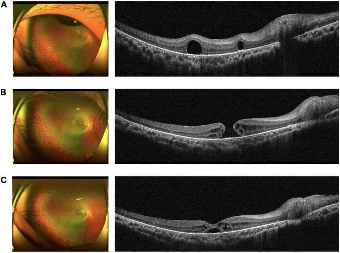A comparative medical series illustrating the progression and spontaneous resolution of a macular hole (MH) following surgical intervention. The figure presents three stages (A, B, C), each containing a color fundus photograph (left) and a corresponding spectral-domain optical coherence tomography (OCT) cross-section (right).