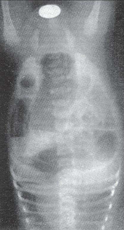 This diagnostic image is a lateral abdominal and pelvic X-ray of a neonate, positioned in an inverted or 'head-down' orientation for the Wangensteen-Rice technique. The radiograph shows gas-filled bowel loops, specifically outlining the distal rectum as the air rises to the highest anatomical point in this position. A radiopaque metallic marker is placed externally on the perineal dimple to serve as a reference point. The primary educational focus is the assessment of an anorectal malformation (imperforate anus). The image allows for the measurement of the distance between the distal rectal gas bubble and the perineal marker, which is critical for classifying the defect as a 'high' or 'low' lesion and determining the appropriate surgical approach. This clinical application is most valid after 14–24 hours of life to ensure bowel gas has reached the terminal rectum. The imaging highlights key findings in pediatric radiology and neonatal gastrointestinal surgery.