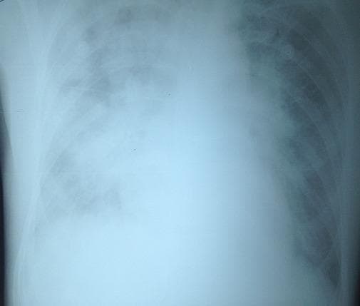 This diagnostic image is a front-facing chest X-ray (radiography) demonstrating extensive bilateral pulmonary opacities. The lungs exhibit a mixed alveolar-interstitial pattern characterized by diffuse, fluffy infiltrates and reticular markings. The opacities are distributed throughout both lung fields, with a more pronounced 'white-out' appearance in the lower zones and a noted asymmetric severity where the left lung appears more densely involved than the right. Notably, the cardiac silhouette remains within normal size limits, showing no evidence of cardiomegaly or significant distortion of the heart borders. These radiographic findings, when associated with acute respiratory distress post-transfusion, are highly suggestive of non-cardiogenic pulmonary edema, such as Transfusion-Related Acute Lung Injury (TRALI). The image serves as a clinical example of pulmonary parenchymal involvement without cardiac failure, essential for differentiating TRALI from Transfusion-Associated Circulatory Overload (TACO) in critical care and hematology education.