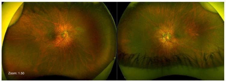 Ultra-widefield pseudocolor fundus images of the right and left eyes demonstrating characteristics of high myopia. Both images show a eutrophic optic nerve head with notable peripapillary ring atrophy, which appears more pronounced in the left eye. A posterior staphyloma is evident bilaterally, visible as a deepening and subtle contour change in the posterior pole. The macular architecture appears unremarkable with homogeneous pigmentation, showing no signs of exudative change or significant choroidal neovascularization. Retinal vascularization is visible extending to the far periphery, which is typical for this presentation. These clinical photographs are used to assess myopic retinal changes and monitor for secondary complications like retinal thinning or staphyloma progression. The image captures the characteristic tigroid fundus appearance often associated with myopic stretching of the retinal pigment epithelium and choroid.