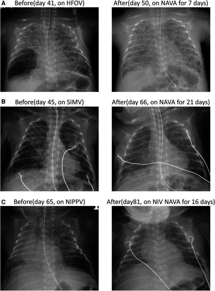 This comparison chart consists of six anteroposterior neonatal chest X-rays organized into three cases (A, B, and C) to demonstrate the resolution of localized pulmonary interstitial emphysema (PIE). Each case provides a 'Before' image—on High-Frequency Oscillatory Ventilation (HFOV), Synchronized Intermittent Mandatory Ventilation (SIMV), or Nasal Intermittent Positive Pressure Ventilation (NIPPV)—and an 'After' image following treatment with Neurally Adjusted Ventilatory Assist (NAVA) or Non-Invasive NAVA. In the 'Before' images, localized PIE is identified by abnormal collections of air within the interstitial space, appearing as cystic, radiolucent (dark) bubbles and coarse lung markings, primarily in the right lower lobe (Cases A and B) and left lower lobe (Case C). Medical devices including endotracheal tubes, umbilical venous catheters, and ECG leads are visible. The 'After' images show significant radiological improvement, characterized by the disappearance of the lucent cystic lesions, more homogenous lung parenchymal density, and improved lung aeration, illustrating the clinical efficacy of NAVA in managing neonatal air leak syndromes.