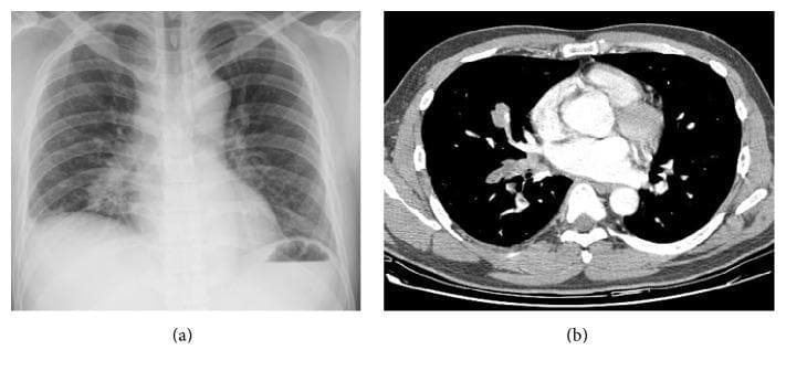 This composite clinical image presents diagnostic findings in a 41-year-old male with lung cancer and dyspnea. Image (a) is a posterior-anterior chest X-ray showing an ill-defined, heterogeneous area of increased opacity in the right lower lung field, suggestive of a parenchymal lesion. Image (b) is an axial contrast-enhanced CT scan of the thorax at the level of the pulmonary veins. The CT demonstrates high-density, irregular lesions within the right superior and right inferior pulmonary veins. These findings represent tumor-associated thrombotic lesions or direct tumor extension, which appear to distend the affected vessels and extend into the adjacent lung parenchyma. The visual evidence illustrates pulmonary vein obstruction syndrome (PVOS) as a complication of lung adenocarcinoma. The images are categorized as clinical imaging and x-ray radiography, suitable for intermediate-level medical education regarding oncological thoracic complications and vascular involvement in lung cancer.