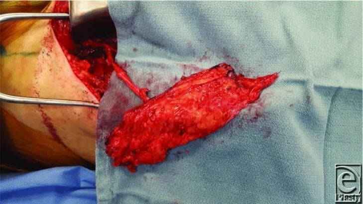 This clinical photograph captures a surgical procedure involving a fascia-only anterolateral thigh (ALT) flap during its elevation. The flap is a rectangular, erythematous tissue mass with a textured, granular surface, resting on blue surgical drapes. A key anatomical feature shown is the vascular pedicle, appearing as a thin, tubular structure extending from the flap back into the donor site in the thigh. The surgical site is visible to the left, showing dissected subcutaneous tissue and exposed muscle, held open by a metal retractor. The surrounding skin shows surgical markings and preparation for harvesting. This image serves as a detailed educational example of reconstructive surgery techniques, specifically illustrating the harvest of a microvascular free flap and the preservation of the vascular pedicle before division. It is highly relevant for plastic and reconstructive surgery training, focusing on flap anatomy, donor site management, and microsurgical preparation.