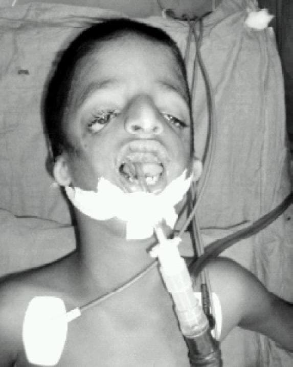 This clinical photograph shows a pediatric patient with craniofacial features characteristic of Treacher Collins syndrome (mandibulofacial dysostosis), specifically demonstrating downsloping palpebral fissures, coloboma of the lower eyelids, and hypoplasia of the malar and mandibular regions. The patient is undergoing airway management, with a size 4 uncuffed RAE (Ring-Adair-Elwyn) endotracheal tube in situ. The tube is properly secured using adhesive white tape across the mandible and maxilla. Connected to the endotracheal tube is a standard ventilation circuit adapter. Additional clinical monitoring is visible, including an ECG electrode placed on the upper left chest wall. This image serves as a clinical example of a 'difficult airway' scenario due to micrognathia and retrognathia in a patient scheduled for cleft palate repair. The educational focus is on the anatomical challenges of intubation in syndromic patients and the application of specialized endotracheal tubes to maintain a clear surgical field.