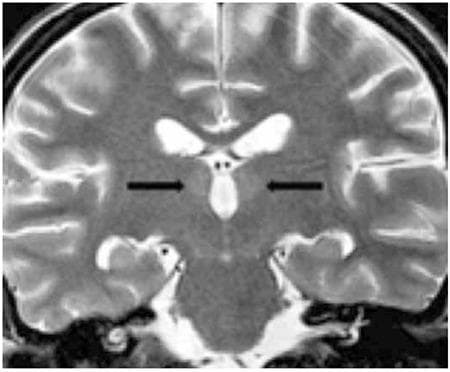 This diagnostic image is a coronal T2-weighted magnetic resonance (MRI) scan of the brain, demonstrating characteristic radiological findings associated with Wernicke encephalopathy. The image reveals symmetrical, weak, and limited increased signal intensity (hyperintensity) localized within the medial thalami, indicated by bilateral black arrows. Additional signal changes are noted along the surfaces facing the third ventricle. These findings are highly suggestive of thiamine deficiency-related metabolic derangement. The scan captures key anatomical structures including the lateral ventricles, the third ventricle, and the temporal lobes. This imaging is clinically significant for medical education in neurology and radiology, illustrating the classic distribution of lesions in acute Wernicke encephalopathy, which can occur in patients with nutritional deficiencies secondary to conditions like leukemia or long-term parenteral nutrition without vitamin supplementation.