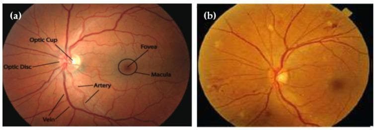 This comparison chart features two retinal fundus images used for the diagnostic assessment of hypertensive retinopathy. Image (a) depicts a normal retinal fundus with clearly labeled anatomical structures, including the optic disc, optic cup, fovea, and macula. The vasculature displays healthy arteriolar and venous distribution with distinct margins and normal caliber. In contrast, image (b) illustrates manifestations of hypertensive retinopathy. This diagnostic image shows characteristic microvascular abnormalities, including generalized arteriolar narrowing and the presence of scattered clinical lesions. Distinctive visual features in the pathological image include light-yellow, irregularly shaped cotton-wool spots or hard exudates across the retinal surface and a more muted, orange-yellow fundus background. These visuals serve as educational material for ophthalmology and internal medicine, highlighting the ocular impact of systemic hypertension. Key educational concepts include the identification of normal retinal landmarks versus pathological signs such as vascular wall changes and exudative lesions used in clinical staging and computer-aided diagnosis (CAD).