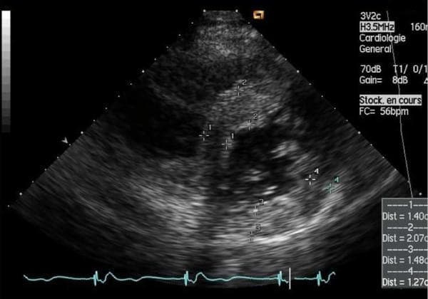 Diagnostic Image: Transthoracic echocardiogram in a parasternal short-axis (PSAX) view at the mid-ventricular level. The image demonstrates significant concentric left ventricular hypertrophy (LVH), a common cardiac manifestation of Fabry disease. The left ventricular (LV) myocardium exhibits increased echogenicity with a relatively preserved homogeneous granular texture. Calipers and numerical annotations indicate quantitative measurements of wall thickness: Point 1 (1.40 cm), Point 2 (2.07 cm), Point 3 (1.48 cm), and Point 4 (1.27 cm), confirming pathologically thickened interventricular septal and posterior walls. An electrocardiogram (ECG) trace is visible at the bottom of the frame for cardiac cycle synchronization. This visual is intended for medical education regarding the diagnostic imaging of storage-disorder-induced cardiomyopathies and the quantification of ventricular remodeling.