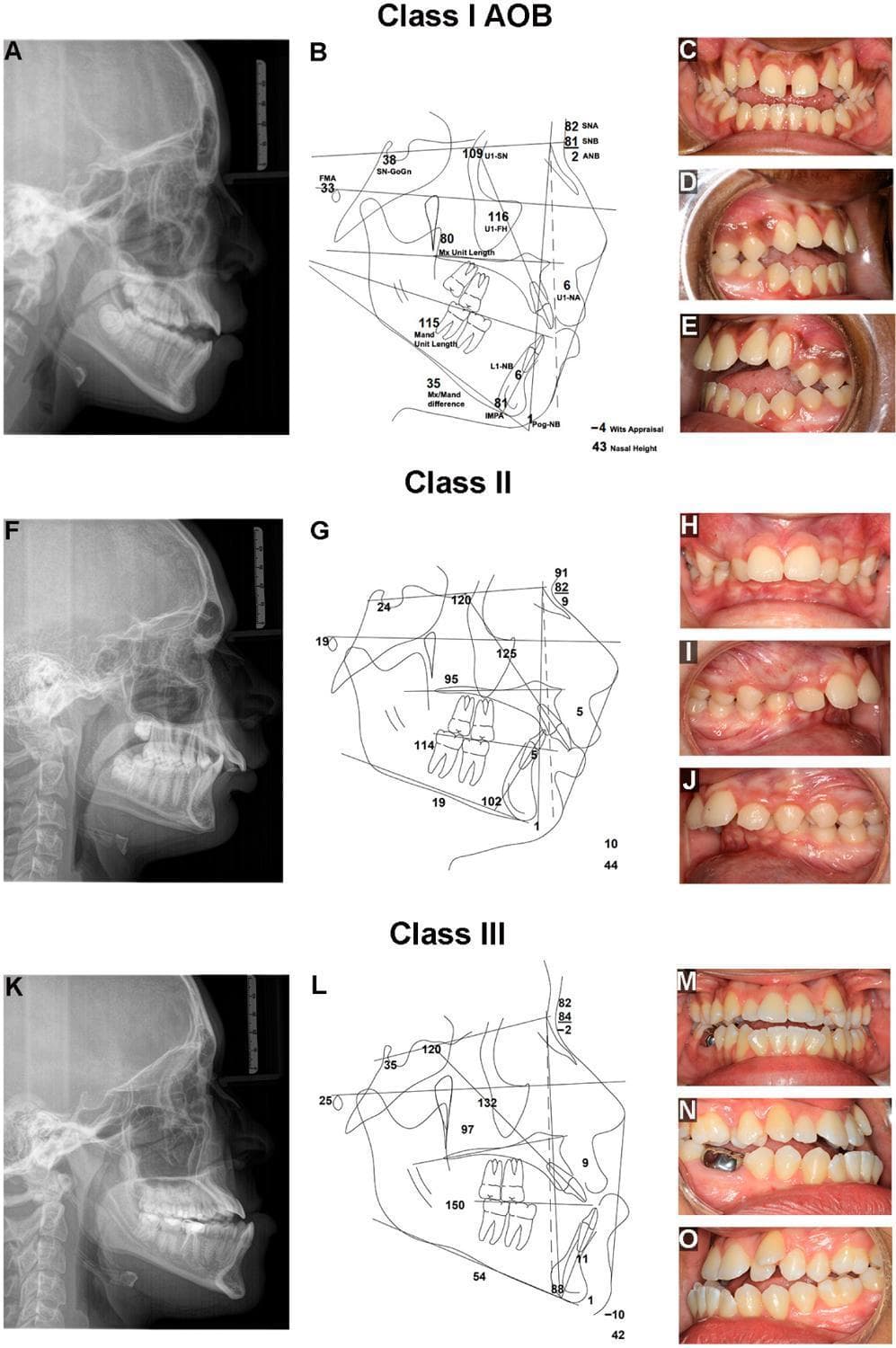 This composite educational graphic illustrates three primary types of dentofacial disharmony (DFD) and malocclusion: Class I Anterior Open Bite (AOB), Class II, and Class III. Each category is represented by a lateral cephalogram (radiograph), a corresponding cephalometric tracing with linear and angular measurements, and a triplet of intraoral clinical photographs (frontal, right, and left views). The Class I AOB section demonstrates a high mandibular plane angle, increased lower facial height, and vertical spacing between the maxillary and mandibular incisors. The Class II presentation shows excessive overjet, proclined maxillary incisors, and a deep bite. The Class III section highlights mandibular prognathism characterized by a negative overjet (underbite) and compensatory incisor inclinations. The cephalometric tracings include key diagnostic values such as SNA, SNB, and ANB angles, Wits appraisal, and Frankfort Horizontal relationships. This visual resource is designed for orthodontic and maxillofacial surgery training to aid in the differential diagnosis of skeletal and dental alignment disorders.