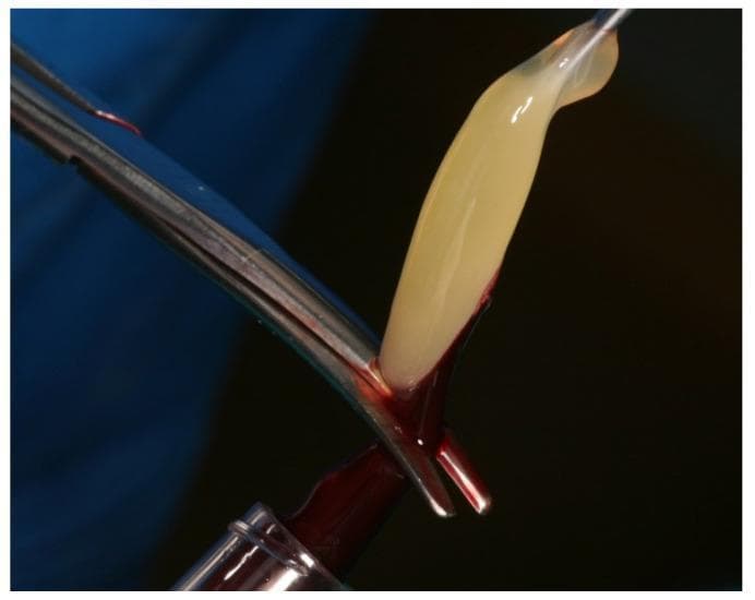 This clinical photograph captures an intraoperative procedure demonstrating the manual separation of platelet-rich fibrin (PRF) from a concentrated red blood cell (RBC) clot. The PRF component is visualized as a yellowish-white, translucent, gelatinous fibrin matrix, which is held securely by metallic atraumatic tweezers. Positioned immediately below it is the dense, dark-red erythrocyte-rich clot. A sharp metallic surgical blade is shown performing the excision at the junction of the two layers to isolate the PRF for clinical use. This process follows a standardized centrifugation protocol of autologous venous blood, typically used in regenerative medicine for applications such as sinus augmentation, implant dentistry, or wound healing. The visual highlights the distinct textural and color differences between the concentrated leukocyte-platelet-rich fibrin and the remaining hematoma components, emphasizing the precision required for autologous graft preparation.