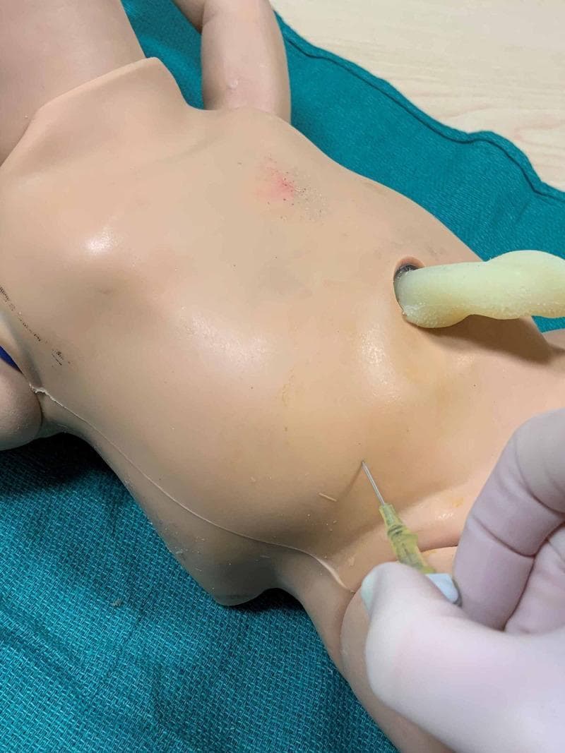 A close-up clinical photograph showing a procedural demonstration of a neonatal abdominal paracentesis on a medical training manikin. The manikin is placed in a supine position on a green surgical drape. A gloved hand is visible, holding a 20- or 22-gauge angiocatheter inserted at a 45-degree angle into the lower quadrant of the manikin's abdomen. The site of insertion is approximately two-thirds the distance along a line drawn from the umbilicus to the anterior superior iliac spine, which is a key clinical landmark for safe paracentesis to avoid internal structures. Near the center of the abdomen, an open hole represents the umbilicus, with a yellowish tube-like structure protruding. The task trainer is used to teach neonatology procedures, specifically the drainage of abdominal ascites. The syringe connected to the catheter contains a yellowish fluid, simulating the appearance of serous ascitic fluid or povidone-iodine solution used in simulation training.