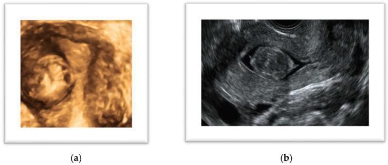 Educational diagnostic ultrasound images of a uterine leiomyoma (fibroid). Image (a) presents a 3D ultrasound in coronal view, demonstrating a solid, well-defined mass with a rounded and slightly lobulated morphology. The reconstruction reveals clear boundaries and a heterogeneous tissue density within the uterine environment. Image (b) shows a saline contrast sonohysterography (SHG) in a sagittal plane. This modality highlights a FIGO type 0 submucosal leiomyoma, appearing as a discrete, hypoechoic, rounded lesion entirely within the endometrial cavity. The instillation of saline provides a clear anechoic (dark) contrast around the lesion, delineating its relationship with the endometrial lining and myometrial junction. These images illustrate key diagnostic techniques for evaluating symptomatic uterine lesions, such as abnormal uterine bleeding or subfertility, and are essential for preoperative surgical planning.