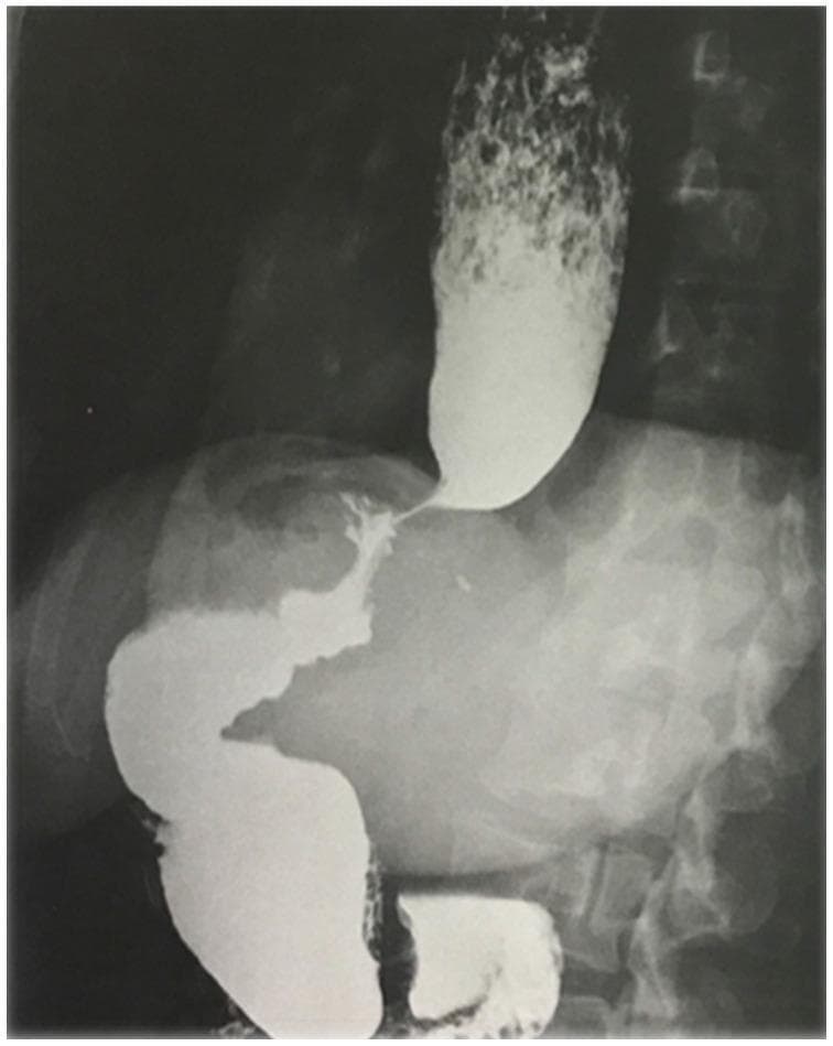 A barium swallow X-ray (fluoroscopy) of the upper gastrointestinal tract demonstrating a markedly dilated esophagus. There is a prominent accumulation and stasis of contrast medium within the esophageal lumen, with visible mottling suggestive of retained food particles. The distal esophagus exhibits a sharp, smooth tapering near the esophagogastric junction, characteristic of a 'bird's beak' deformity often associated with achalasia. Below the diaphragm, the gastric sleeve from a previous laparoscopic sleeve gastrectomy (LSG) is visible with regular contours and normal transit of the contrast bolus that has managed to pass. The image illustrates secondary achalasia or post-surgical esophageal dysmotility, highlighting the contrast between the dilated thoracic esophagus and the restricted passage through the lower esophageal sphincter.