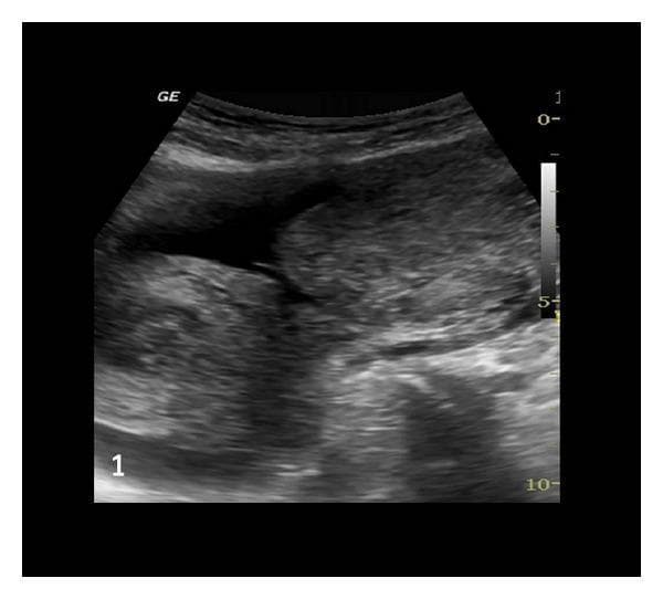 This diagnostic ultrasound image in the pelvic region demonstrates a congenital Müllerian duct anomaly. The primary finding is a unicornuate uterus, characterized by an elongated, single-sided uterine horn with a relatively uniform, intermediate echogenicity. Adjacent to the main uterine body, a distinct, noncommunicating rudimentary horn is visible. Both uterine structures appear empty, without visible gestational sacs or products of conception. Significant anechoic areas representing free fluid (hemoperitoneum) are noted surrounding the uterine structures, consistent with clinical suspicion of a ruptured rudimentary horn. The image provides a key visualization of Class II Müllerian anomalies, specifically highlighting the anatomical relationship between a unicornuate uterus and its associated rudimentary horn, which is critical for diagnostic differentiation and surgical planning in emergency gynecological presentations.