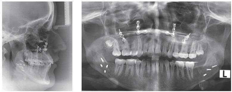 This composite of diagnostic images includes a lateral cephalometric radiograph and a panoramic radiograph showing the maxillofacial region of a post-surgical patient. The radiographs demonstrate the outcome of orthognathic surgery, specifically a bimaxillary procedure involving maxillary impaction and mandibular setback. Key findings include multiple radiopaque metallic hardware: bilateral Y-shaped zygomatic plates secured with screws in the maxilla and orthodontic miniscrews positioned between the canines and bicuspids in the mandible. The panoramic view shows a full dental arch with several radiopaque dental restorations (fillings) and evidence of endodontic treatment (root canals). The mandibular condyles are visible and symmetrical, and the alveolar bone height appears well-maintained. The lateral cephalogram highlights the skeletal profile changes, showing the soft tissue silhouette and the counterclockwise rotation of the maxillomandibular complex. These findings are consistent with orthodontic-surgical management of Class III malocclusion and condylar hyperplasia, showcasing final stabilization with skeletal anchorage and rigid internal fixation.