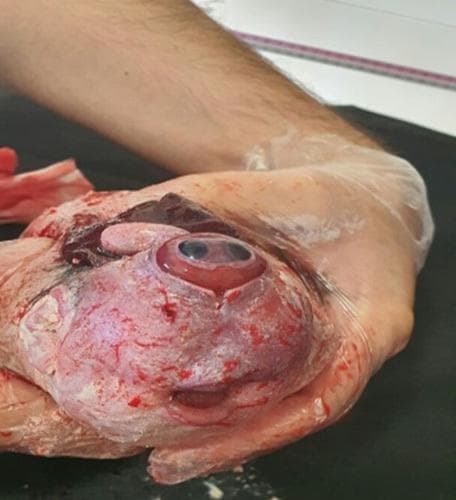 Clinical photograph of a neonatal specimen demonstrating severe craniofacial malformations consistent with holoprosencephaly. The central feature is cyclopia, characterized by a single median orbit located in the midline of the face. The orbit contains a fused or partially divided ocular globe with visible iris and pupil structures, partially covered by rudimentary eyelids. Superior to the orbit, a cylindrical skin-covered appendage known as a proboscis is present. The nose is absent (arrhinia). Inferior to the median eye, a malformed oral cavity is visible, showing a small mouth opening and a glimpse of the tongue. The surrounding facial skin displays significant discoloration, congestion, and visible superficial vasculature. Superior to the proboscis, there is evidence of exposed neural tissue or severe cranial defect, possibly related to anencephaly or a significant skull vault deficiency. This image serves as a clinical example of extreme midline defects arising from the failure of the prosencephalon to divide during embryonic development.