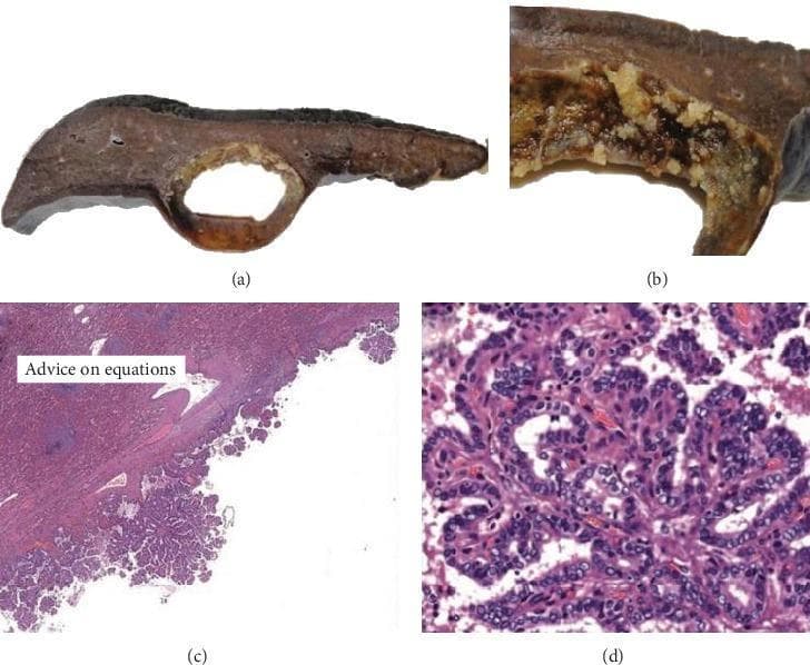 This composite image illustrates the macroscopic and microscopic features of a metastatic papillary thyroid carcinoma within the spleen. Panels (a) and (b) are clinical photographs showing a cross-section of an ovoid, cystic splenic lesion approximately 5.5 cm in diameter. The gross specimen reveals thin cyst walls with internal friable, yellowish papillary projections protruding into the lumen. Panels (c) and (d) are H&E-stained photomicrographs showing the corresponding histology. At low magnification (4x, Panel c), the cyst wall is lined by complex papillary structures with fibrovascular cores extending into the cystic space. At high magnification (20x, Panel d), the neoplastic cells exhibit classic nuclear features of papillary thyroid carcinoma, including cuboidal morphology, clear 'Orphan Annie eye' nuclei, and prominent longitudinal nuclear grooves (nuclear bars). The images demonstrate a rare case of splenic metastasis from a primary thyroid malignancy, emphasizing the importance of recognizing characteristic cytological features in unconventional anatomical sites.