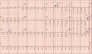 This diagnostic image is a 12-lead electrocardiogram (ECG) demonstrating a narrow-complex tachycardia, specifically identified as atypical atrial flutter. The tracing exhibits a 2:1 conduction ratio, where two P waves are visible for every QRS complex. A key diagnostic feature is the presence of upright flutter waves in the inferior leads (II, III, aVF), annotated with blue arrows, suggesting high-to-low atrial activation. In the precordial leads (V1-V6), the flutter waves remain positive across the entire sequence (noted by black arrows), demonstrating an 'absent precordial transition' that is characteristic of a left atrial origin rather than typical cavotricuspid isthmus (CTI)-dependent right atrial flutter. The ECG lacks the classic 'sawtooth' undulating morphology, instead showing discrete flutter waves. These findings are clinically significant in the context of post-ablation arrhythmias and tachycardia-mediated cardiomyopathy, helping to differentiate between focal atrial tachycardia and macroreentrant circuits originating in the left atrium.
