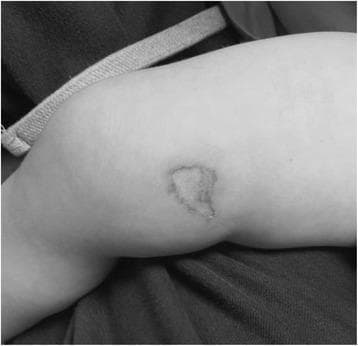 Clinical photograph of a pediatric patient (1.5 years old) showing a localized chemical burn on the medial aspect of the right thigh, superior to the knee. The lesion represents a 0.25% Total Body Surface Area (TBSA) full-thickness burn. Visually, the burn is characterized by an irregularly shaped, somewhat quadrilateral area of pale, blanched skin, indicating deep tissue damage and potential insensitivity. The borders of the wound are clearly demarcated with a slightly raised edge, but notably lack significant surrounding erythema or gross inflammation in this specific stage of presentation. The skin within the central wound exhibits textural changes consistent with full-thickness destruction of the epidermis and dermis. This image illustrates the focal, high-intensity tissue damage that can occur from accidental contact with substances such as nail adhesive, requiring careful clinical assessment of burn depth despite a small TBSA percentage.