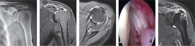This composite figure illustrates the preoperative, intraoperative, and postoperative findings of a complex rotator cuff tear in a left shoulder. Panel 1 is an anteroposterior radiograph demonstrating an elevated acromion, often indicative of chronic rotator cuff pathology. Panels 2 and 3 provide preoperative T2-weighted MRI scans in oblique and transverse planes, respectively; Panel 2 shows a supraspinatus tendon tear with Patte stage 2 retraction, while Panel 3 exhibits mixed hyperintensities within the joint space. Panel 4 presents an intraoperative arthroscopic view confirming a Lafosse I injury of the superior third of the subscapularis tendon. Panel 5 is a follow-up T2-weighted MRI showing successful surgical intervention, characterized by a suture anchor visible in the greater tuberosity of the humerus and evidence of continuous supraspinatus tendon healing. This sequence highlights the diagnostic pathway from radiography and MRI to arthroscopic confirmation and subsequent postoperative evaluation of rotator cuff repair using suture anchors.