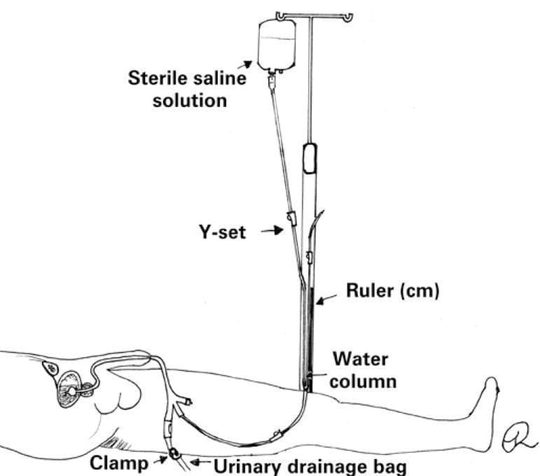 A clinical illustration demonstrating the assembly and components of the Y-set technique for intra-abdominal pressure (IAP) measurement. The diagram features a bag of sterile saline solution suspended from an IV stand, which is connected via tubing to a Y-set connector. One branch of the Y-set is attached to an indwelling urinary catheter (Foley) inserted into the patient to allow for saline instillation into the bladder. The second branch of the Y-set is positioned vertically against a centimeter ruler, creating a manometer setup with a visible water column to measure hydrostatic pressure. A clamp is clearly indicated on the tubing distal to the patient, leading toward the urinary drainage bag, which must be closed during the measurement process to ensure an accurate pressure reading. This setup illustrates a common bedside method used in critical care and surgical settings to monitor for intra-abdominal hypertension or abdominal compartment syndrome.
