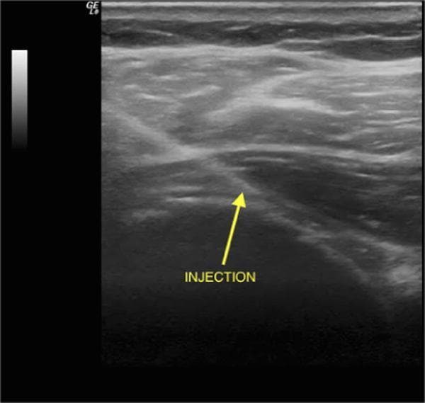 This diagnostic ultrasound image demonstrates an ultrasound-guided intra-articular injection of the glenohumeral joint using a posterior, lateral-to-medial approach. The grayscale B-mode image shows the musculoskeletal anatomy of the shoulder, including the superficial soft tissue and underlying musculature with characteristic striated, heterogenous echogenicity. A hyperechoic, linear needle trajectory is visible, oriented at an oblique angle as it penetrates the deep fascia and approaches the hypoechoic joint space. An annotation arrow labeled 'INJECTION' points to the needle tip positioned at the target site between the humeral head and the glenoid rim. The image illustrates a common orthopedic procedural technique for managing adhesive capsulitis or osteoarthritis, emphasizing the use of real-time imaging to ensure accurate needle placement and optimal delivery of therapeutic agents such as corticosteroids or hyaluronic acid into the joint capsule.
