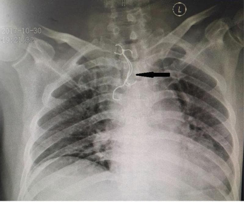 This anterior-posterior (AP) chest radiograph demonstrates a prominent, irregularly shaped radiopaque foreign body in the upper mediastinum, indicated by a black arrow. The structure is located centrally, extending from the level of the thoracic inlet down to the upper thoracic vertebrae (approximately T1-T4), overlying the anatomical path of the esophagus. The foreign body exhibits a complex morphology, consisting of a denser, molded base and thin, curvilinear metallic wires or hooks typical of a dental prosthesis (dentures). Key landmarks include the clavicles and the tracheal air column, which the object partially superimposes. This diagnostic image illustrates a case of accidental foreign body ingestion, highlighting the high radiopacity and sharp features of the prosthetic wires, which pose a clinical risk of esophageal perforation or impaction. The image is a critical tool for medical students and clinicians in identifying non-biological objects and assessing their size and position relative to vital mediastinal structures.