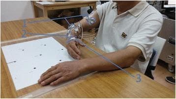 Clinical photograph of a neurophysiological experimental setup designed to study resting tremor in Parkinson’s disease. A subject is seated with their forearm resting on a height-adjustable table, maintaining a relaxed posture to facilitate tremor manifestation. The image illustrates three key components labeled numerically: (1) Bipolar surface Electromyography (EMG) electrodes positioned over several upper limb muscles, including the biceps brachii, triceps brachii, and various forearm flexors and extensors, to record muscle activity. (2) A motion sensor attached to the distal forearm used to capture kinematic data and track degrees of freedom in a magnetic field. (3) Surface electrical stimulation electrodes placed on the dorsal skin of the hand, specifically targeting the innervation zone of the superficial radial nerve near the first interosseous space. This setup evaluates the inhibitory effects of cutaneous afferent stimulation on pathological tremor through simultaneous EMG and kinematic recording.