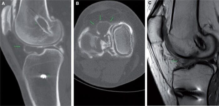 This composite figure presents diagnostic imaging of a cyclops lesion, a common complication following anterior cruciate ligament (ACL) reconstruction. Image A is a sagittal CT arthrogram showing focal soft tissue thickening in the Hoffa’s fat pad region, with visible hardware from a prior ACL repair in the tibia and femur. Image B is a corresponding axial CT arthrogram slice highlighting a well-defined, rounded, 'ballooning' soft tissue mass (indicated by green arrows) located within the anterior intercondylar notch. Image C provides a comparison using a PD-weighted sagittal MRI, which demonstrates a developing cyclops lesion (green arrow) that appears as a low-to-intermediate signal intensity mass anterior to the ACL graft. This collection illustrates the characteristic morphology and anatomical location of localized anterior arthrofibrosis, which clinically correlates with a loss of terminal knee extension. The images highlight the utility of multi-planar CT and MRI in identifying these postoperative soft tissue impingement lesions.